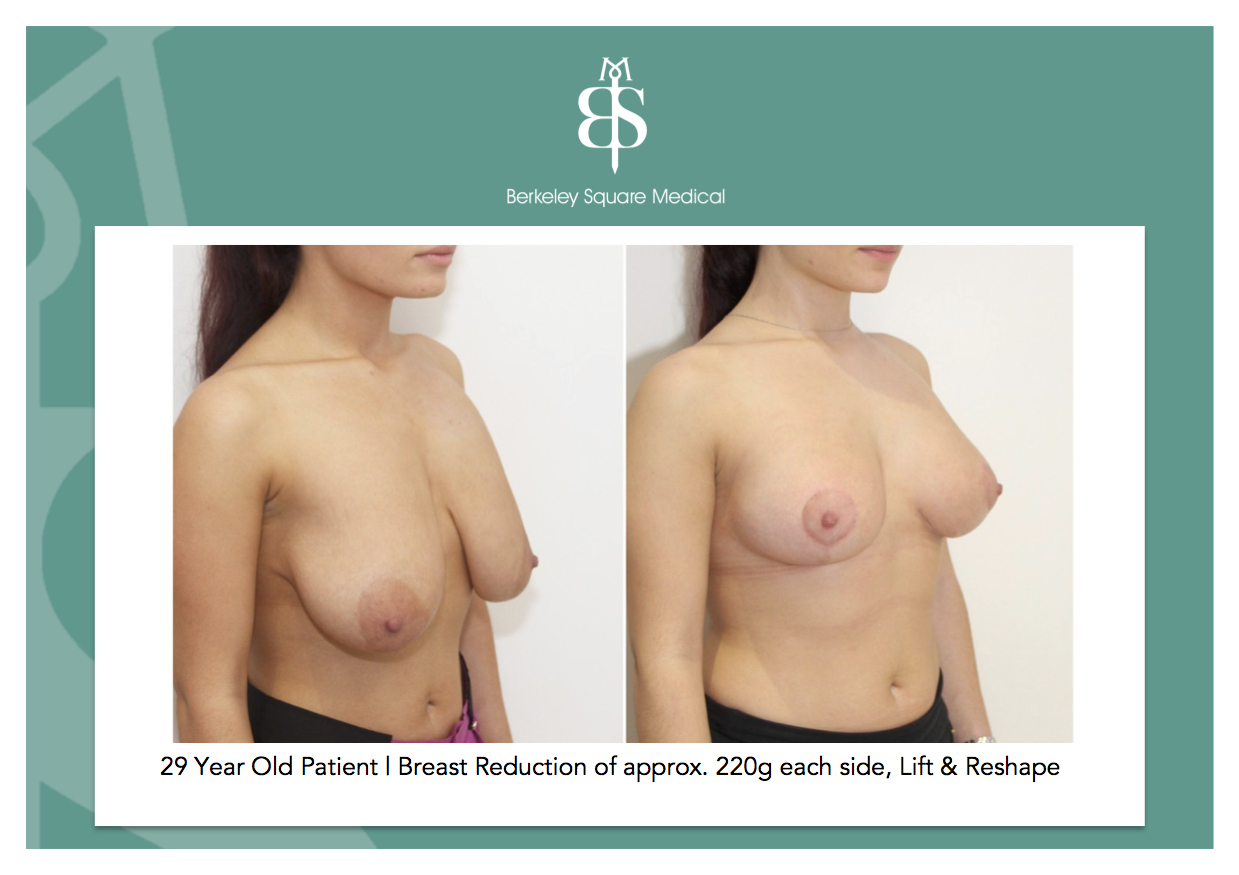 Breast Reduction Cost 121