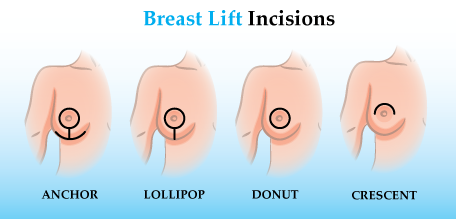 Breast lift incisions