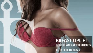 Breast Uplift