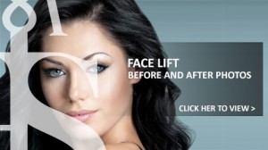 Face Lift Photos