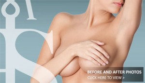 Breast Reduction