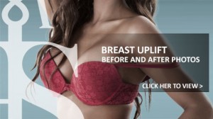 Breast Uplift