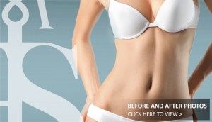 Tummy Tuck