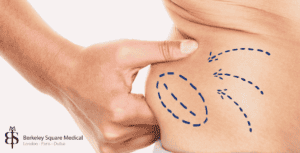 stubborn fat pocket removed by liposuction
