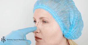 rhinoplasty for older patient
