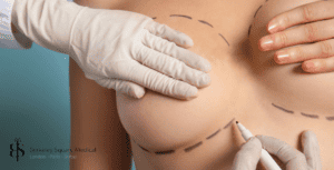 breast lift patient