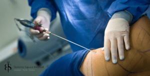 doctor using cannula for fat removal