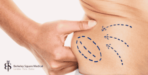 fat pockets are the targets of liposuction