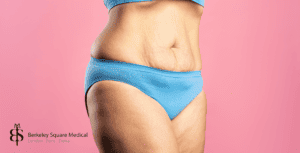 patient before tummy tuck surgery