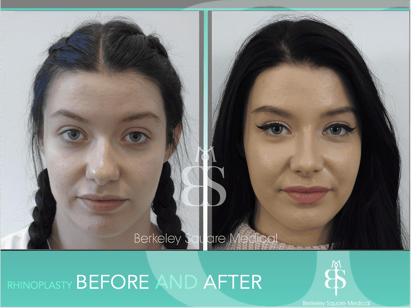 Rhinoplasty Before and After