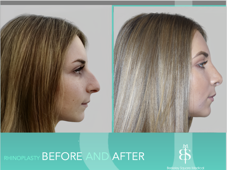 Rhinoplasty Before After London UK 191 Berkeley Square Medical
