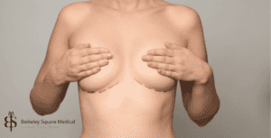breast lift patient
