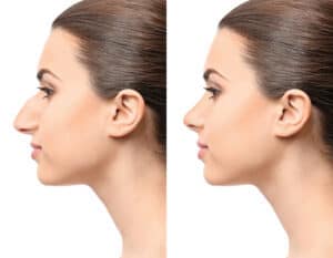 dorsal hump reduction procedure