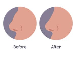 dorsal hump removal before after