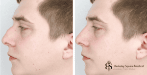 dorsal hump rhinoplasty