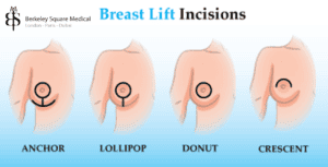 breast lift scar explanation