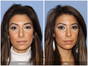 we are very experienced in revision rhinoplasty 