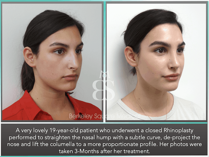 35++ Average nose job cost uk ideas