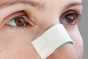 bruised eyes after nose surgery