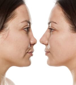 rhinoplasty before and after photos