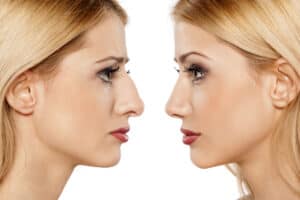 surgical nose reduction before after