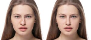 crooked nose fixed by rhinoplasty