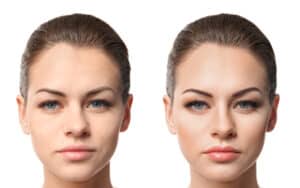 wide nose surgery before and after