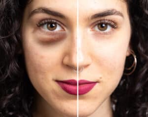 dark circles under the eyes of a young woman