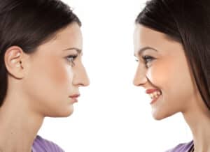 smiling after nose surgery