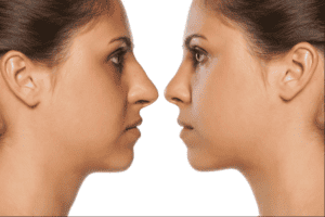 revision nose surgery before and after comparison photo