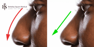 nose hump removal