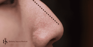 male patient with pollybeak deformity