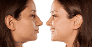 nose surgery 1 month vs 1 year