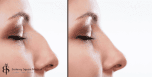 septorhinoplasty surgery before after