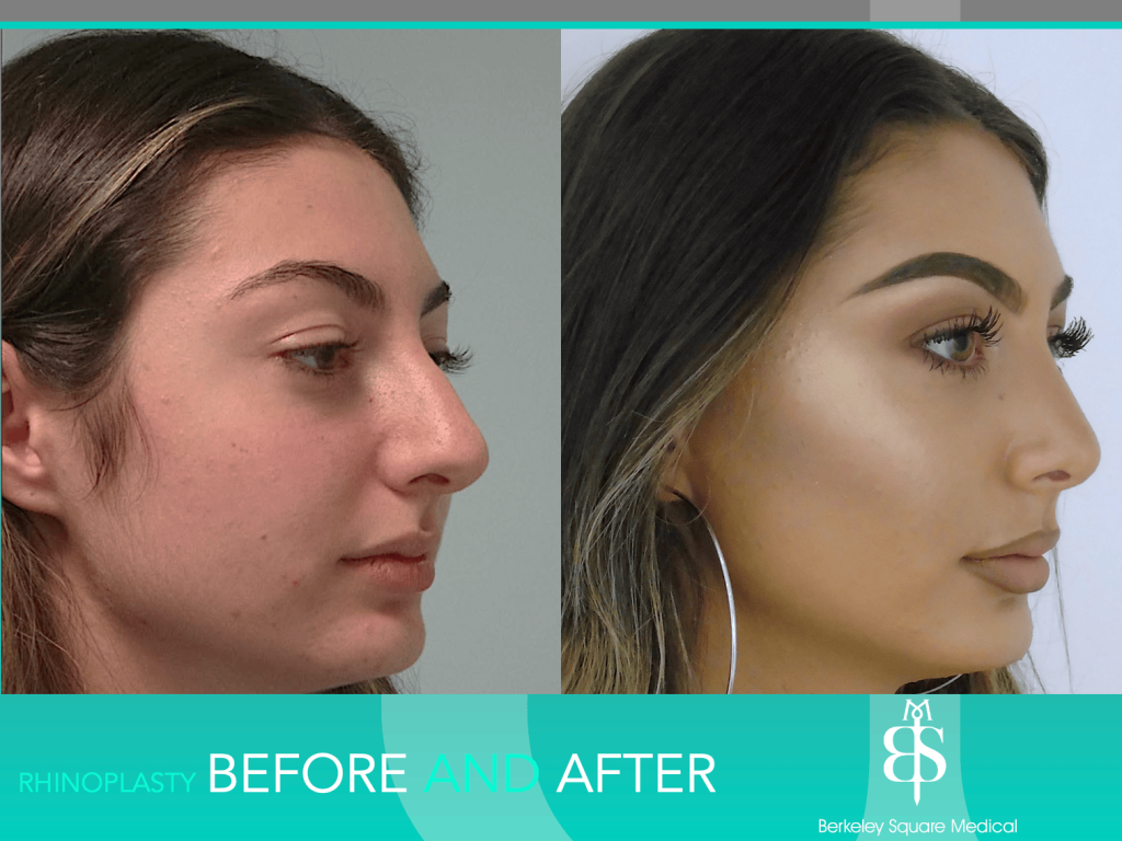 Rhinoplasty Before and After - Berkeley Square Medical - Central ...
