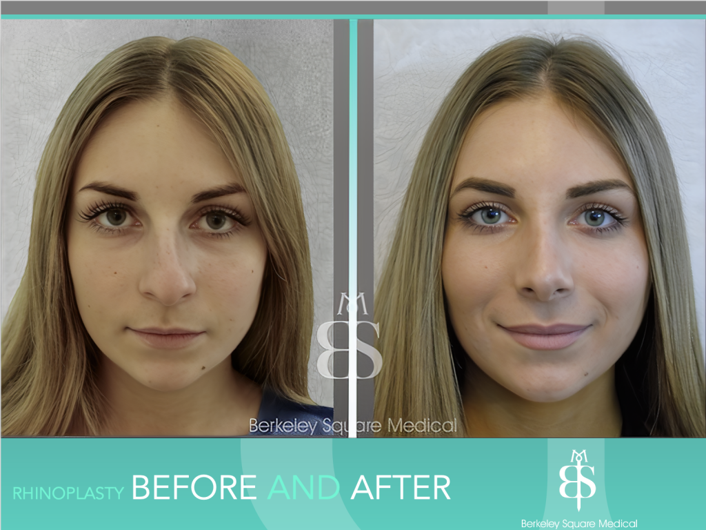 Rhinoplasty Before and After - Berkeley Square Medical - Central ...