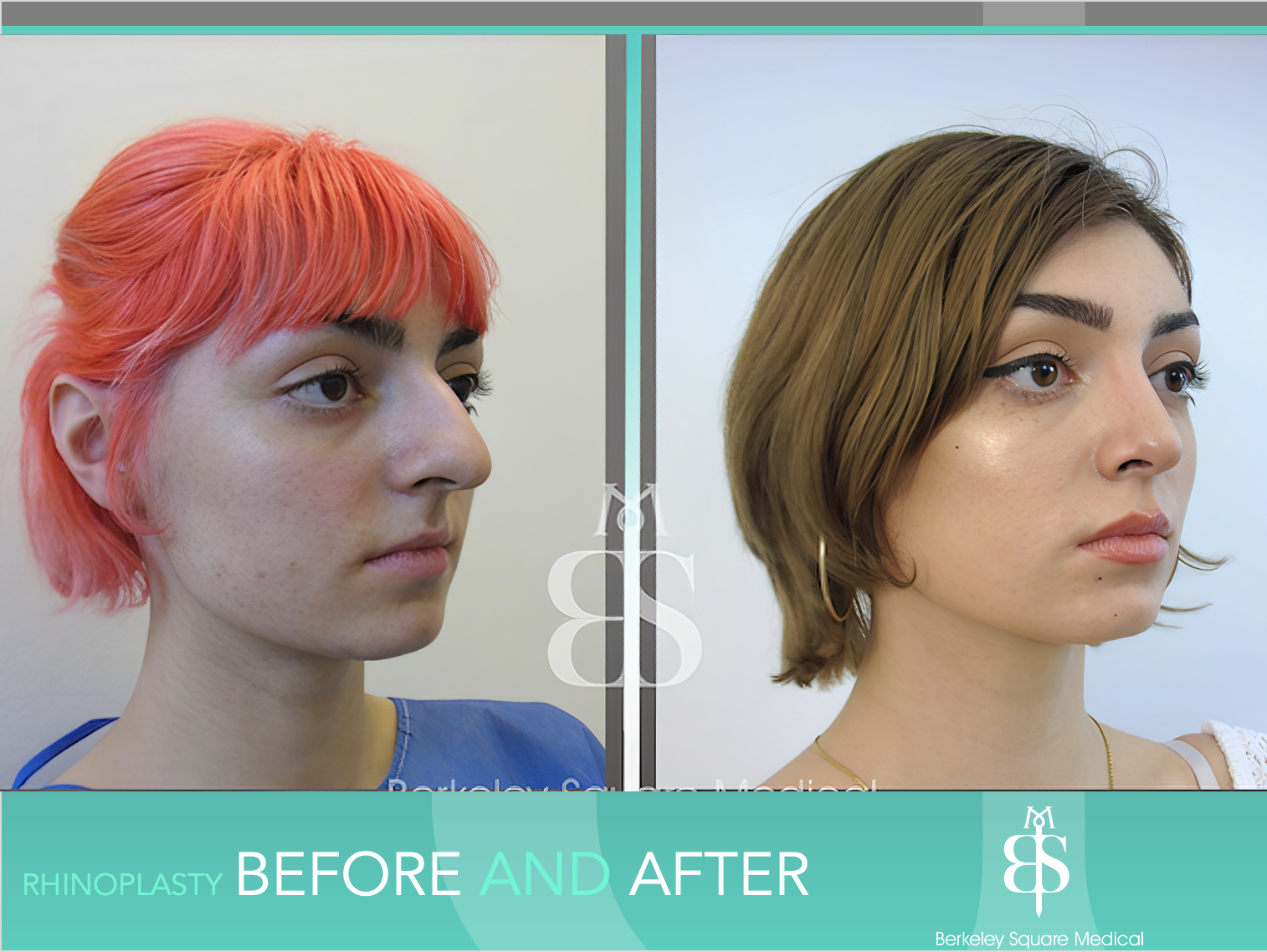 Rhinoplasty Before and After