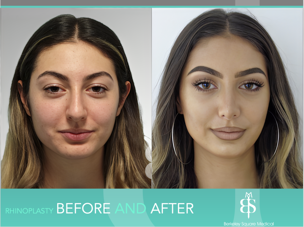 Rhinoplasty Before and After - Berkeley Square Medical - Central ...