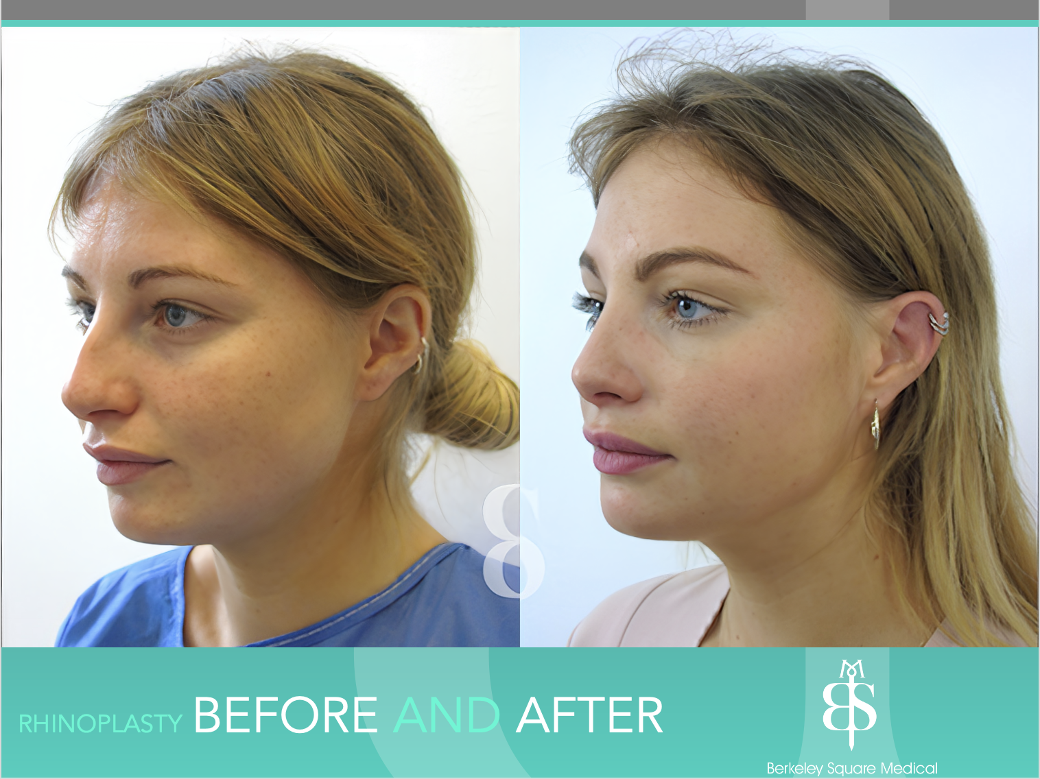 Rhinoplasty Before and After