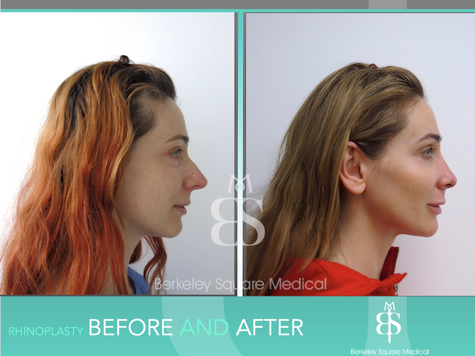 Rhinoplasty Before and After