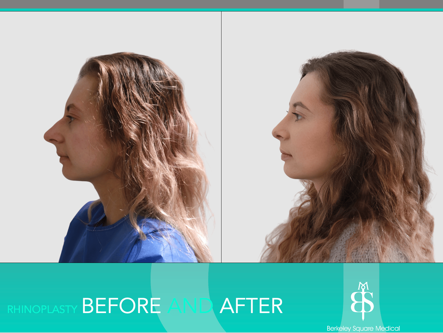 Rhinoplasty Before and After
