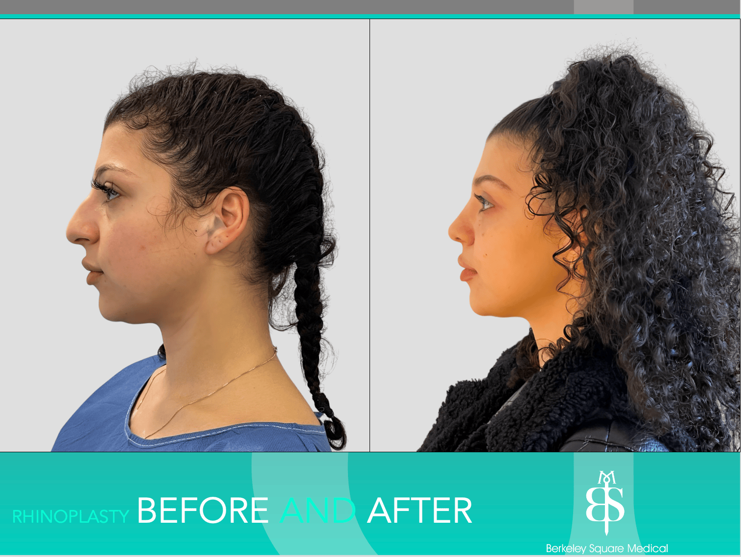Rhinoplasty Before and After