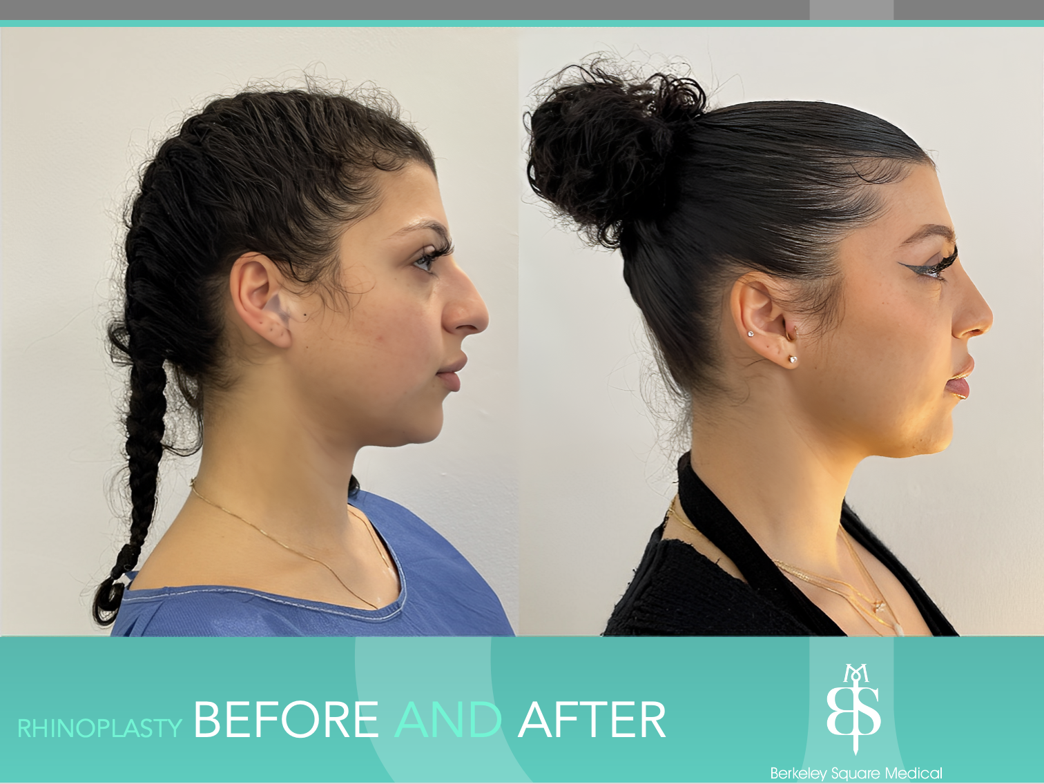 Rhinoplasty Before and After