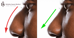 ethnic rhinoplasty patient with hooked nose