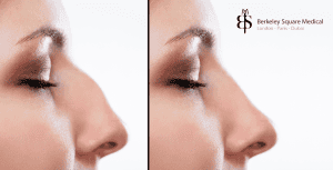 patient before and after hooked nose surgery