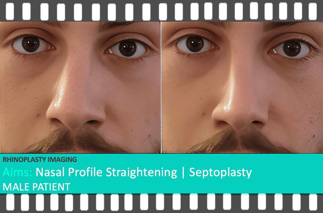 A frontal view of a male patient’s nose, displaying natural asymmetry before surgery and the expected symmetrical outcome achieved through digital imaging. Imaging performed by Mr. Taimur Shoaib’s Rhinoplasty Clinical Team at Berkeley Square Medical.