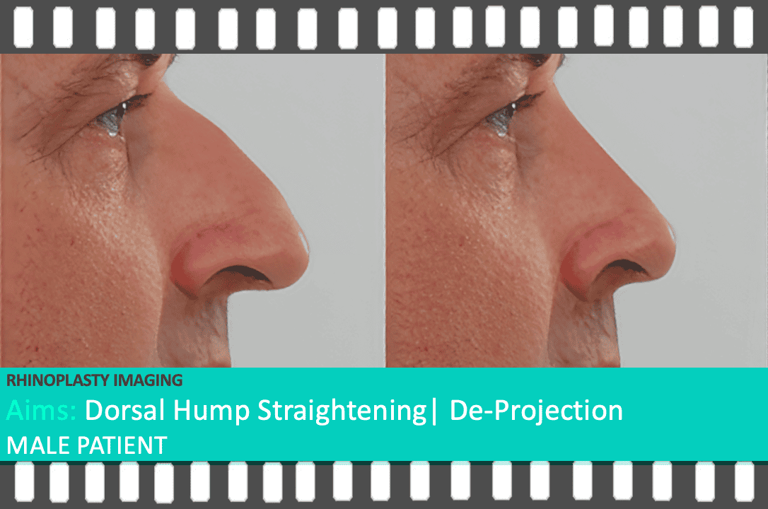 A side profile of a male patient illustrating a prominent dorsal hump in the pre-surgery image and a smoother, straighter bridge in the digital rhinoplasty simulation. Imaging performed by Mr. Taimur Shoaib’s Rhinoplasty Clinical Team at Berkeley Square Medical.