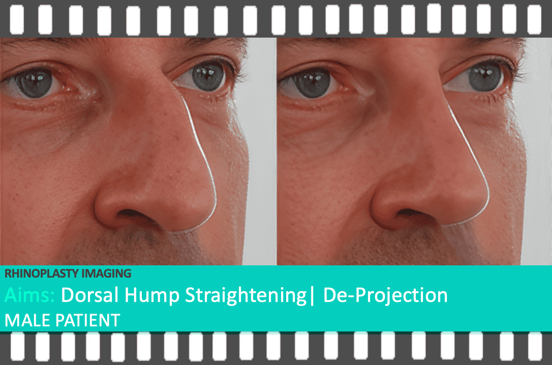 A side-by-side comparison of a male patient’s nose before rhinoplasty and a digitally simulated prediction of his post-surgery result, showing a refined nasal bridge and tip. Imaging performed by Mr. Taimur Shoaib’s Rhinoplasty Clinical Team at Berkeley Square Medical.