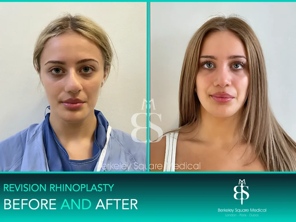 Revision rhinoplasty before and after, front view: a straighter, narrower nose, Mr Taimur Shoaib, London