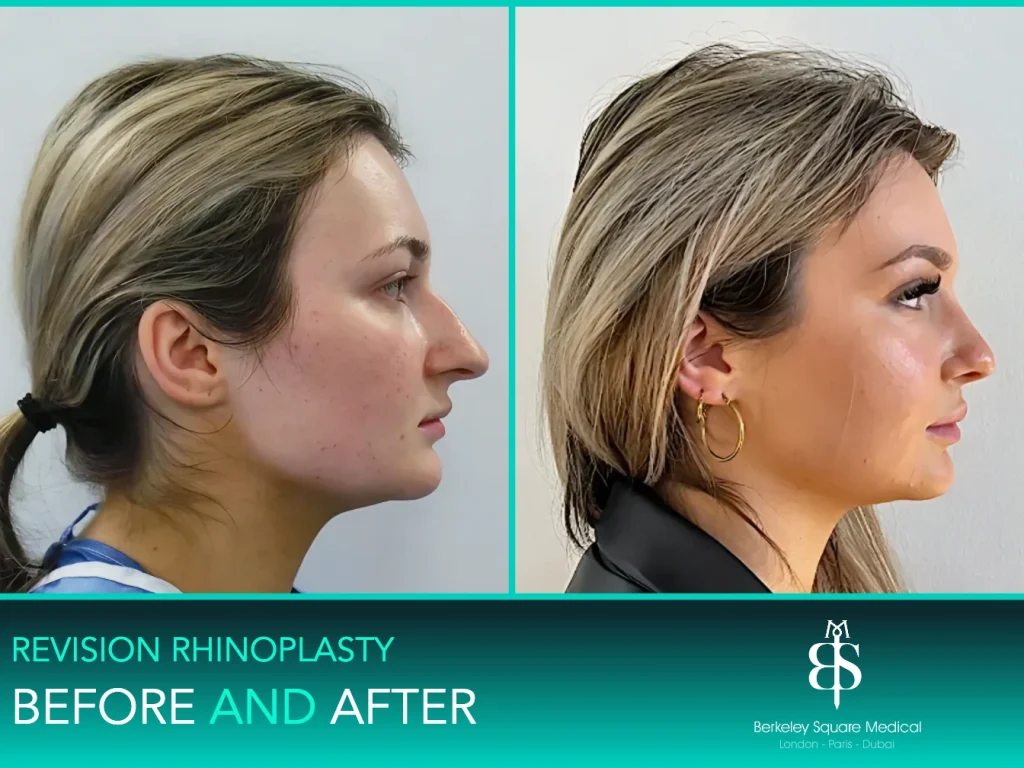Revision rhinoplasty before and after, side profile: straighter bridge and a lifted tip, Mr Taimur Shoaib, London